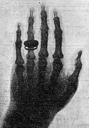 First X-Ray Ever